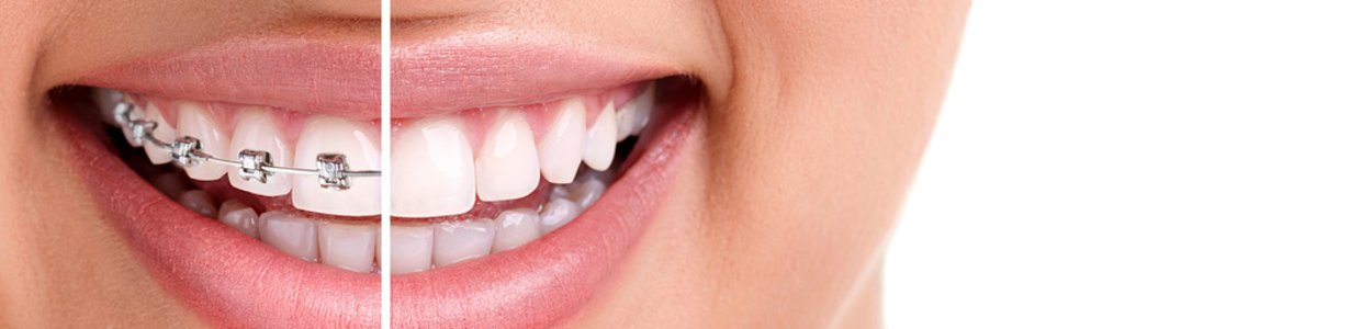 L'orthodontie pour les adolescents